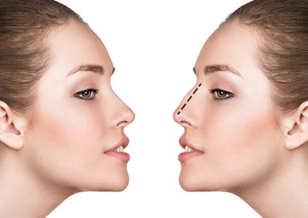 Rhinoplasty: aesthetic nose surgery in Tunisia