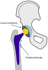 schema of total hip prosthesis