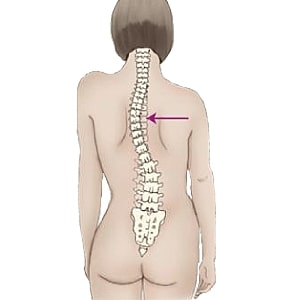 Scoliosis: spinal treatment and surgery in Tunisia