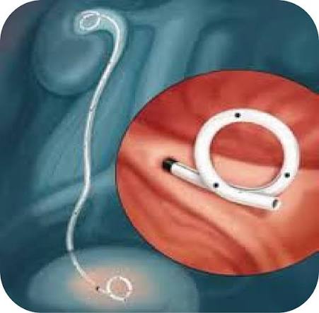 Double J Stent Tunisia