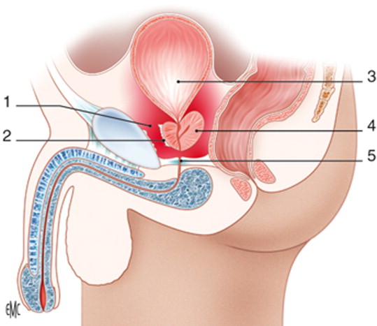 Endoscopic urethrotomy Tunisia price cheap price